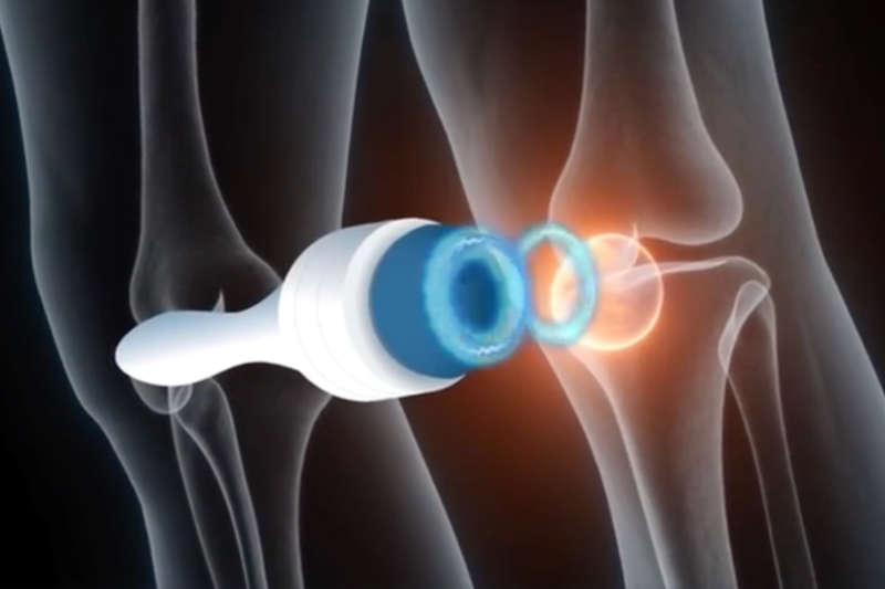 Shockwave Therapy in LA: The Game-Changer for Pain Relief